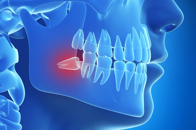 Illustration of jaw in blue and wisdom tooth in red