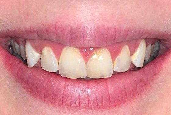 before veneers